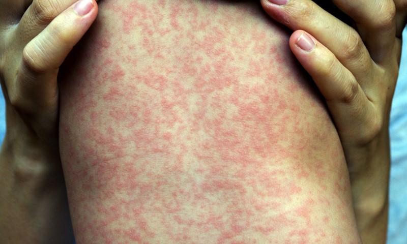 Florida Measles Outbreak Linked To Elementary School