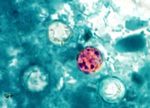 Explosive Diarrhea Cyclosporiasis Cases Surge Across U.S., 48 In 24 Florida Counties